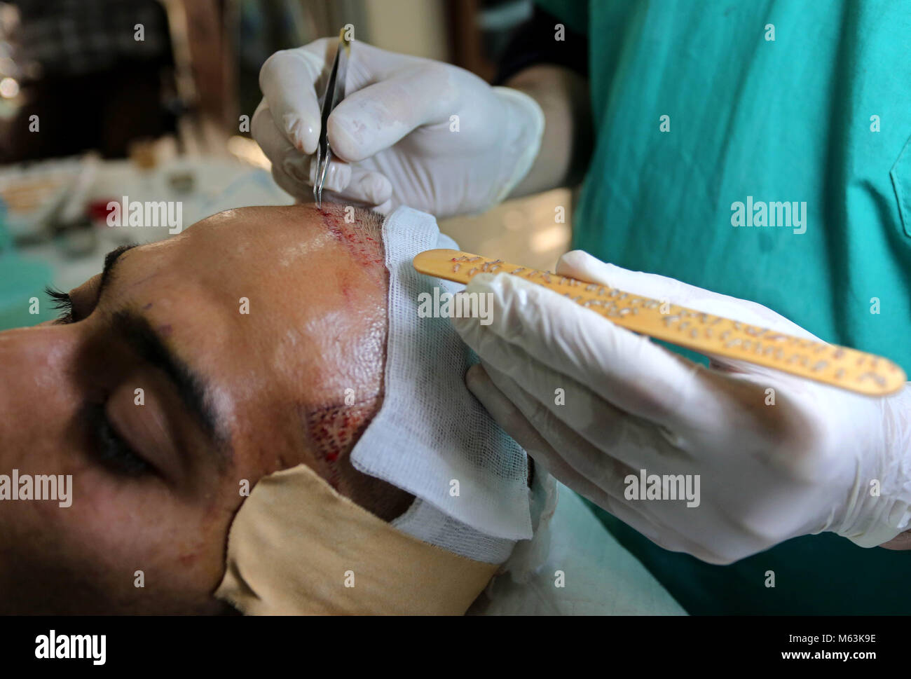 February 28, 2018 - Gaza City, Gaza Strip, Palestinian Territory - A Palestinian doctor Ahmed al-Moghrabi operates on a patient who undergo to Hair transplant surgery at his clinic, in Gaza city on February 28, 2018. Al-Moghrabi opened his clinic last year which is the first of its kind in the Gaza Strip, after years of studying in india and london and came with newest technologies to treat baldness. According to al-Moghrabi he performed about 15 surgery since he opened his clinic each one take from 5 to 10 hours with success rate of 100%, and the surgery cost from 1000 to 1500 $ but economic Stock Photo