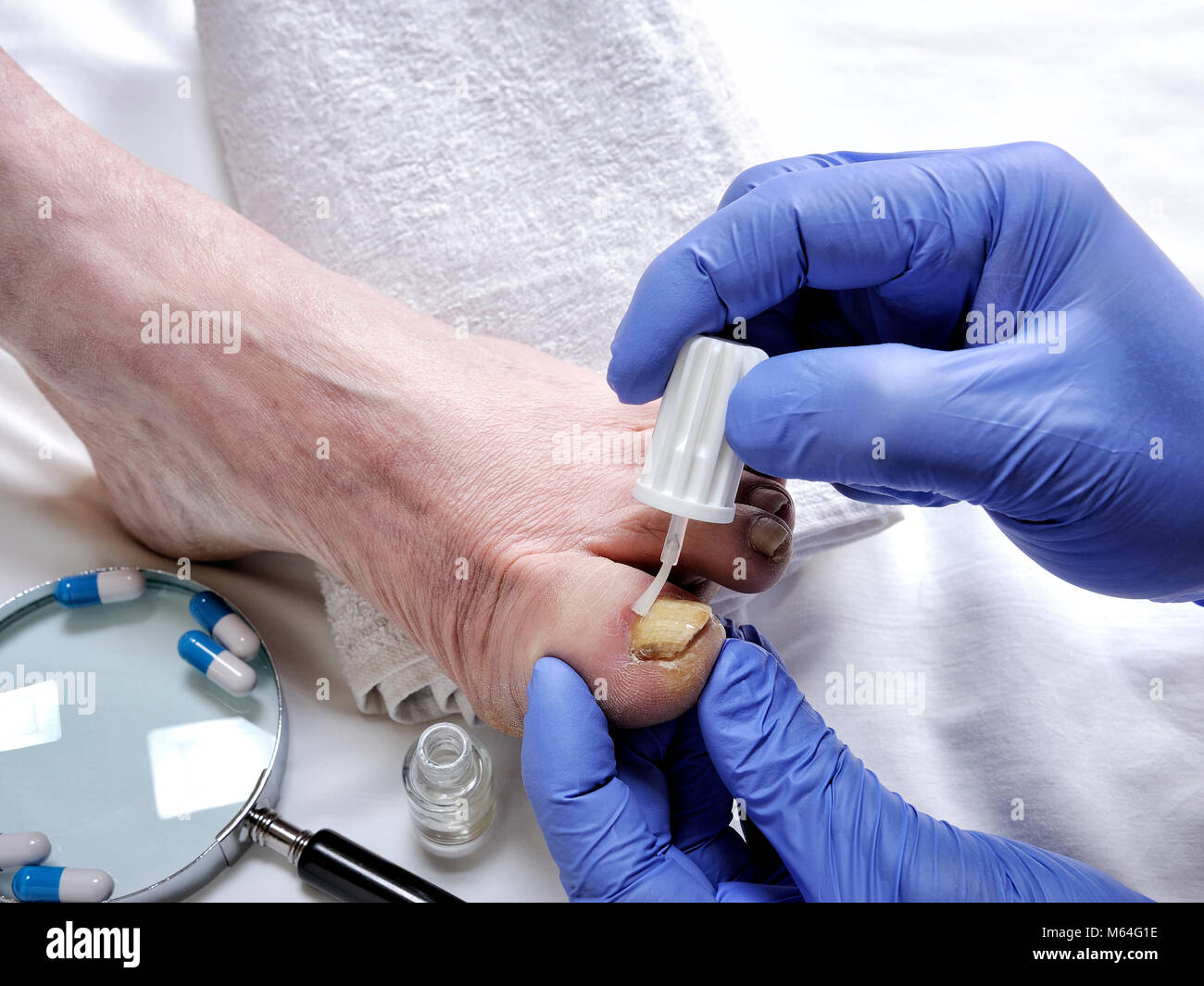 Dermatologist doctor treats a nail affected by onychomycosis following
