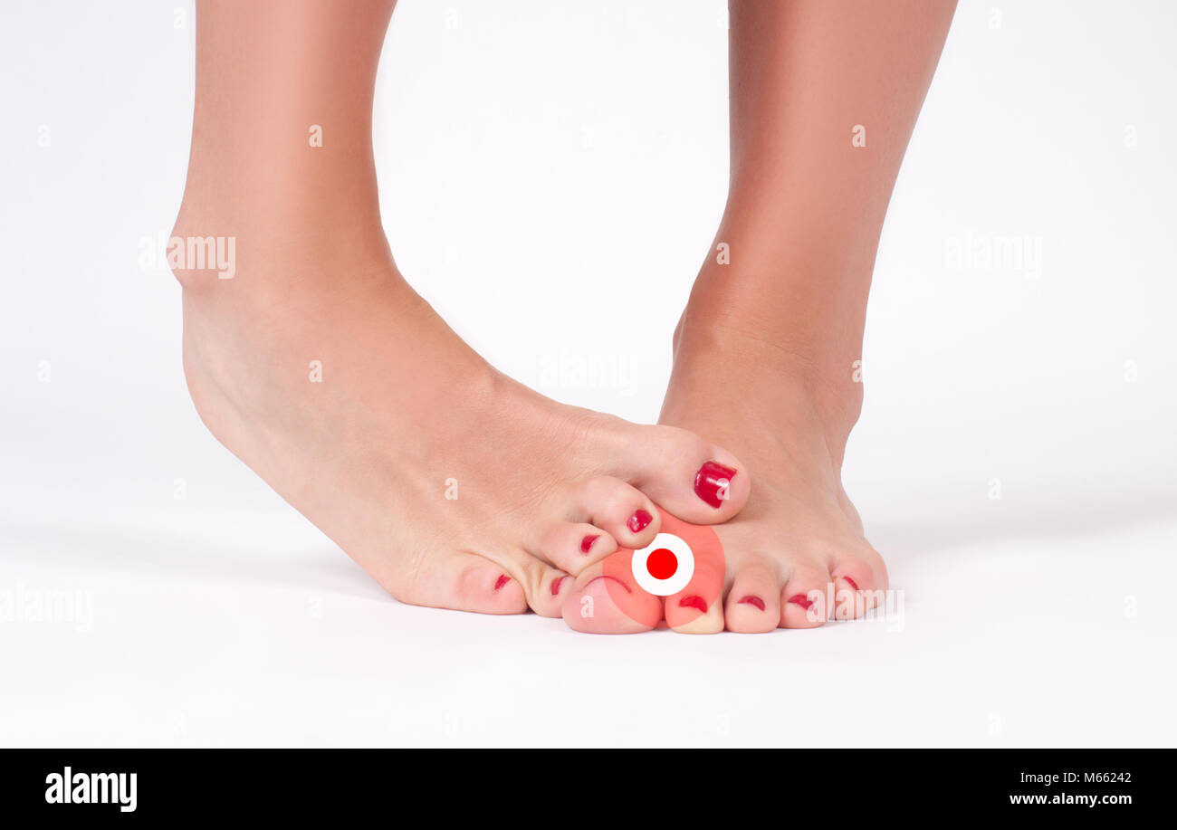 Foot fungus. Beauty and foot care. Female feet on white background. Stock Photo