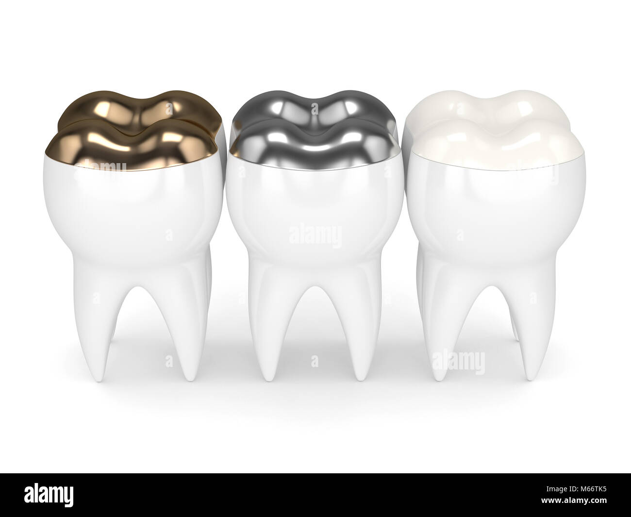 3d render of teeth with gold, amalgam and composite onlay dental