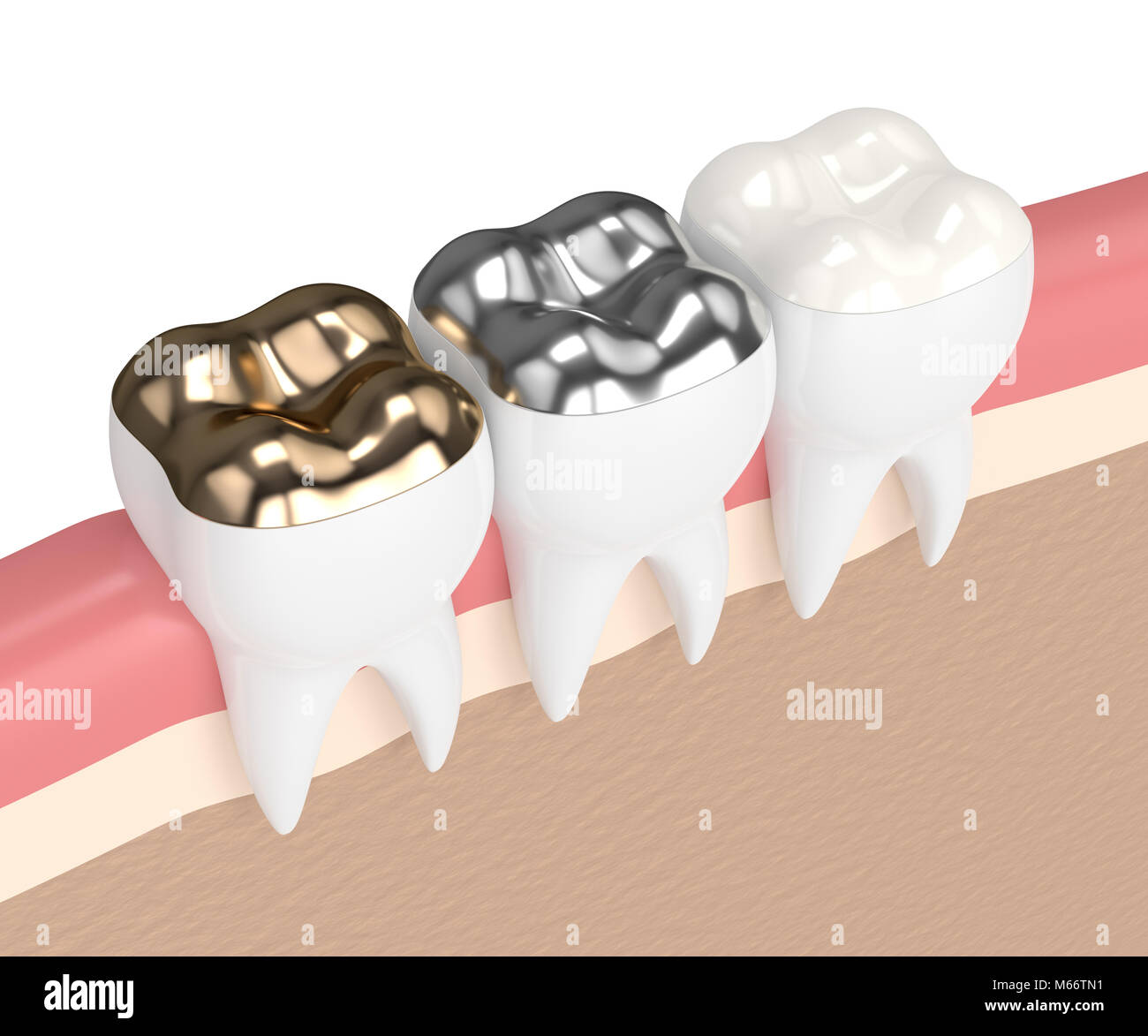3d render of teeth with gold, amalgam and composite onlay dental