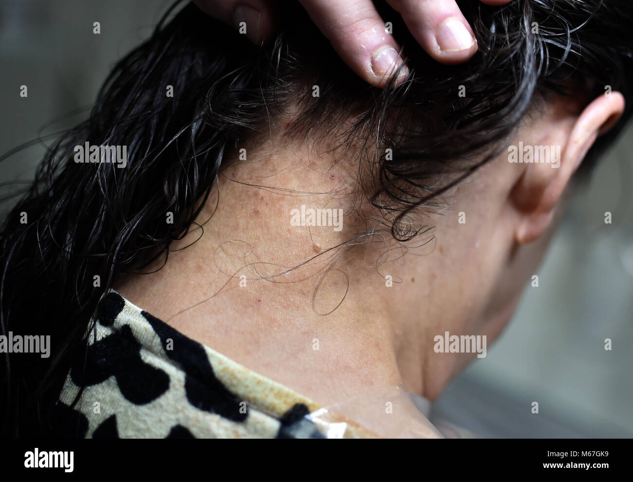 Berlin Germany 01st Mar 18 01 March 18 Germany Berlin Head Lice Bites Credit Britta Pedersen Dpa Zentralbild Zb Dpa Alamy Live News Stock Photo Alamy