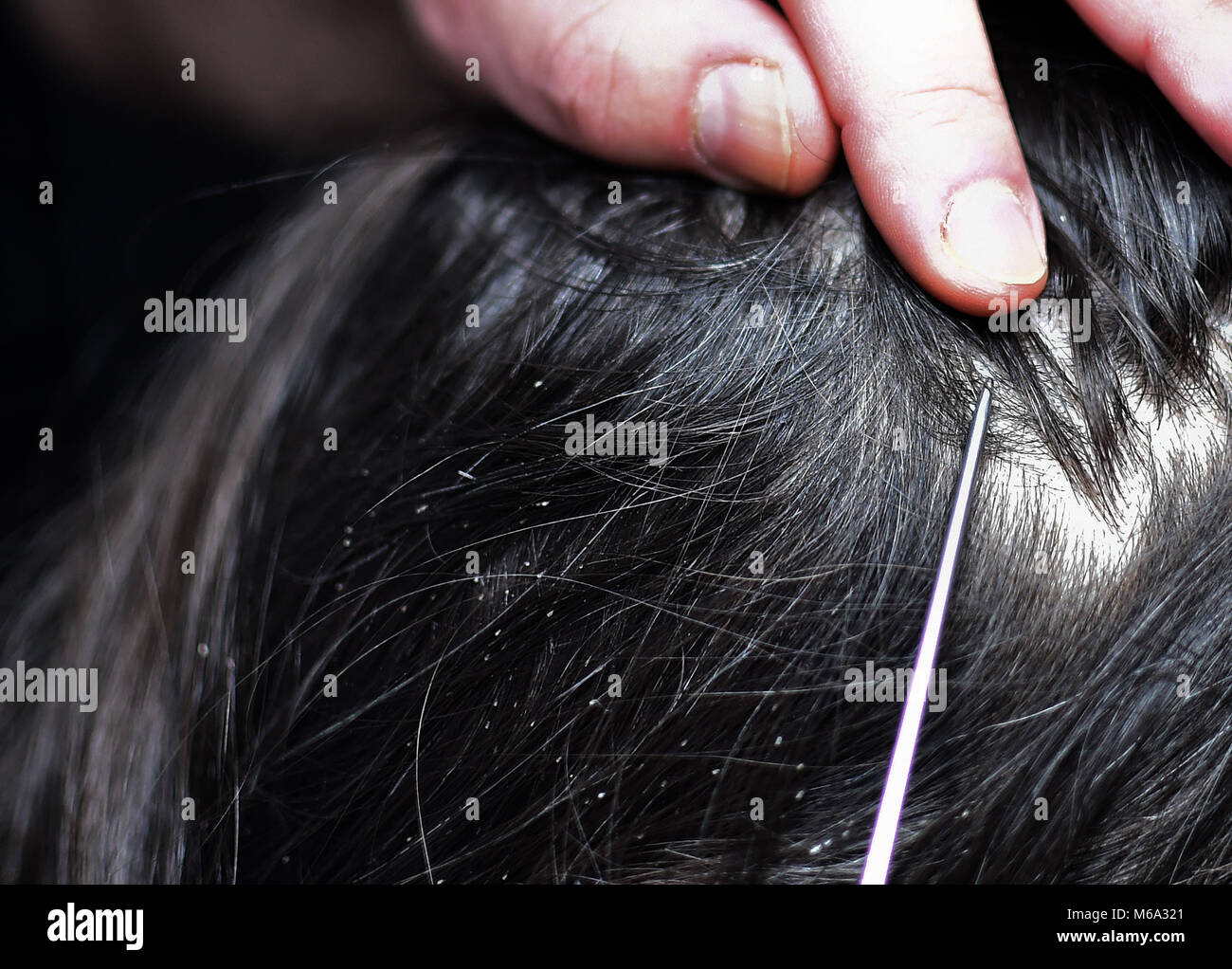 01 March 2018 Germany Berlin Head Lice And Nits On A Scalp
