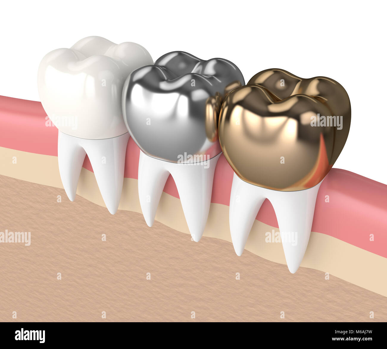 3d render of teeth with gold, amalgam and composite dental crown in