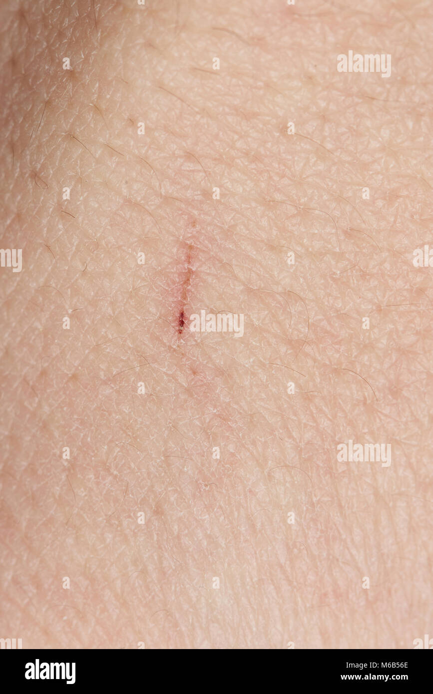 Macro of human skin scratch. Cut on caucasian man skin Stock Photo - Alamy