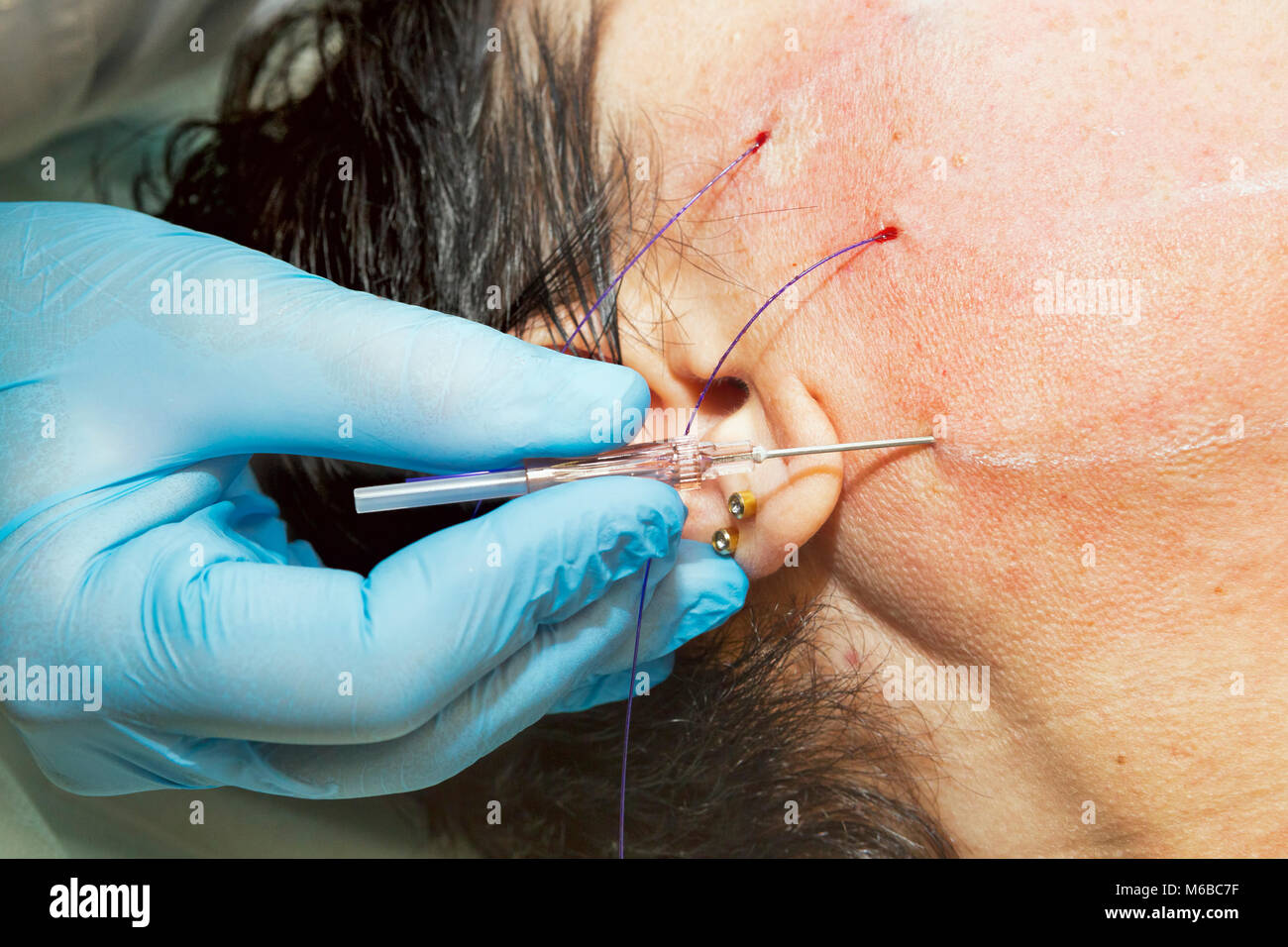 Dermatologist surgeon inserts polylactic acid filaments to perform facial lifting - Selective focus Stock Photo