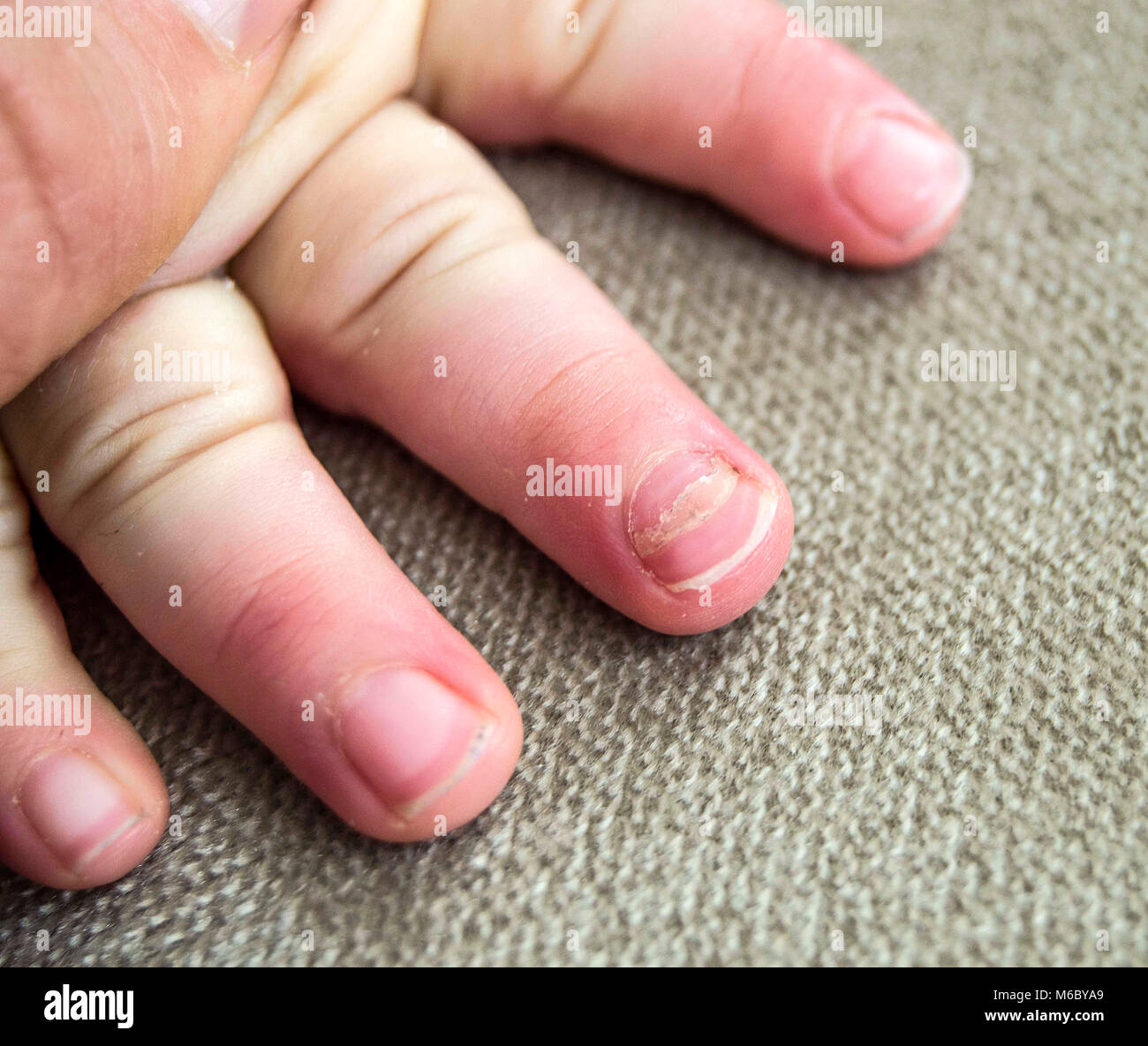 The Nail Regrowth In Children Nail Drop In Babies Re Emergence Of Hand Nails Hand Foot Disease And Nail Drop Stock Photo Alamy The Nail Regrowth In Children Nail Drop In Babies Re Emergence Of Hand Nails Hand Foot Disease And Nail Drop Stock Photo Alamy