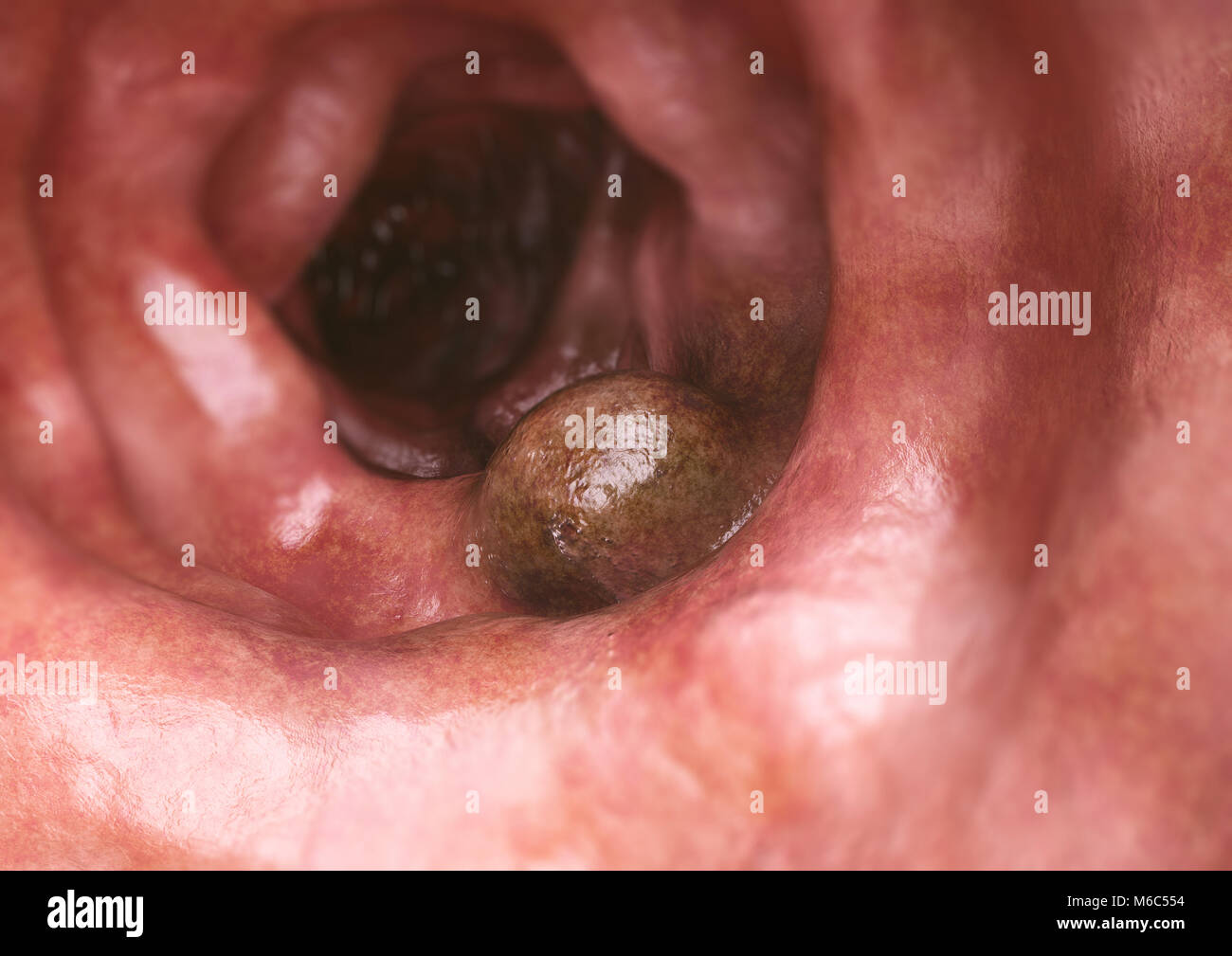 Colon cancer closeup - 3D Rendering Stock Photo