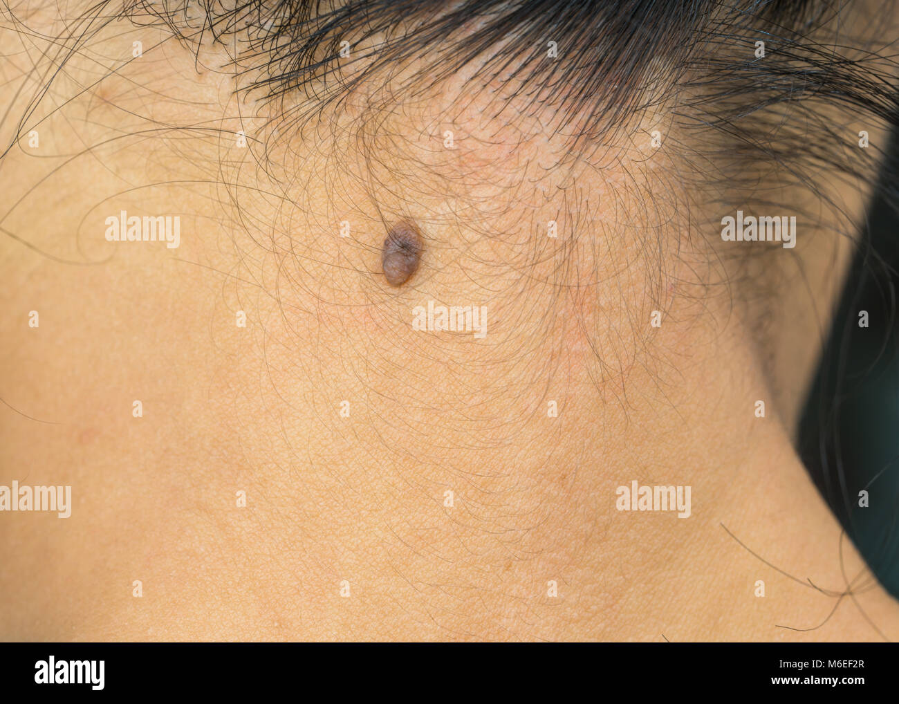moles-on-neck-black-pics-bar