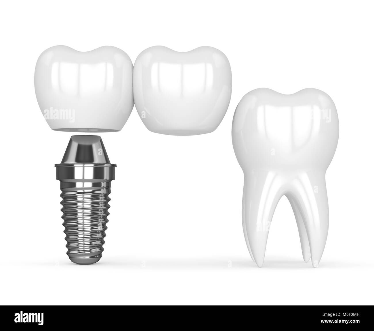 3d render of implant with dental cantilever bridge and healthy tooth