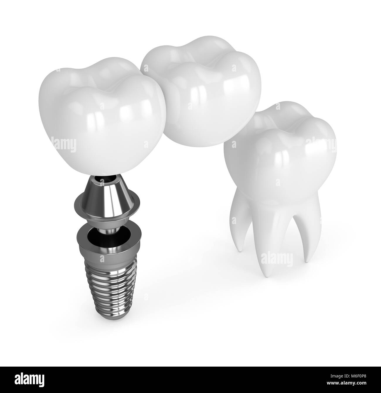 3d render of implant with dental cantilever bridge and healthy tooth isolated over white