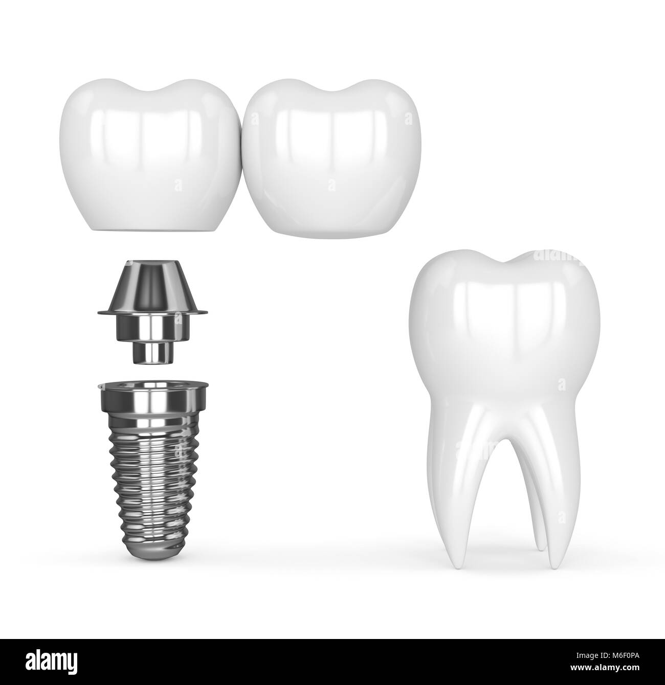 3d render of implant with dental cantilever bridge and healthy tooth isolated over white