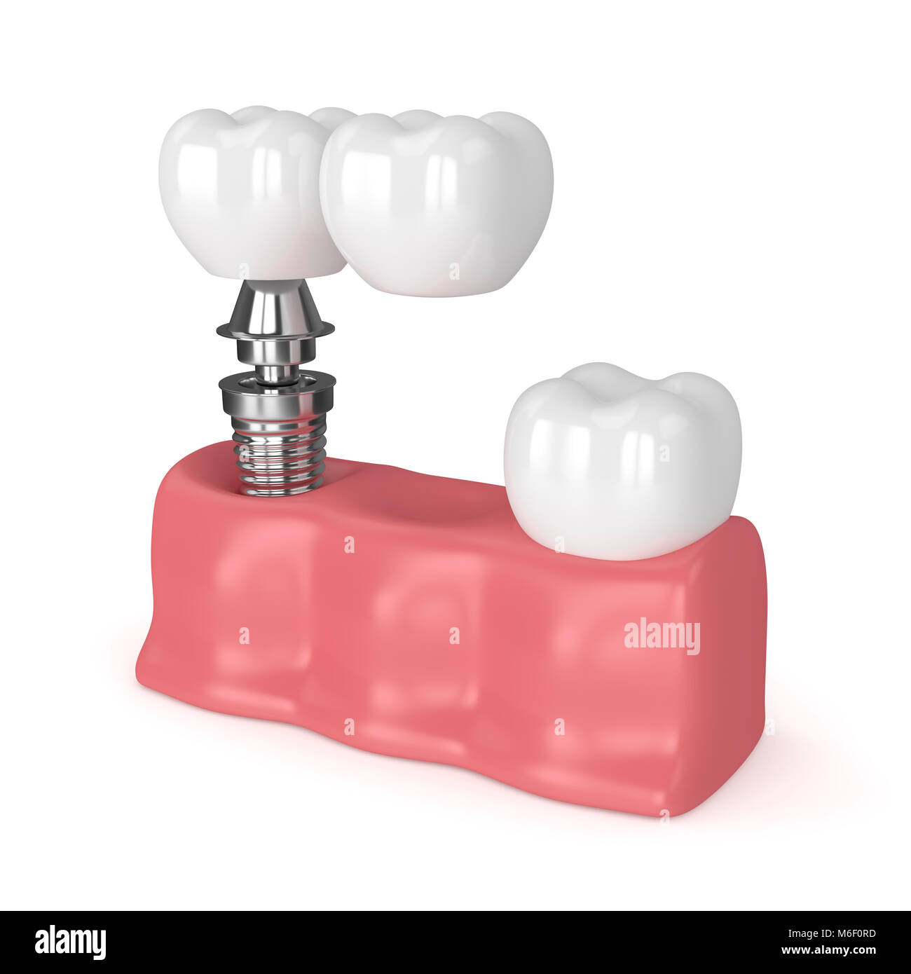 3d render of implant with dental cantilever bridge and healthy tooth in gums isolated over white