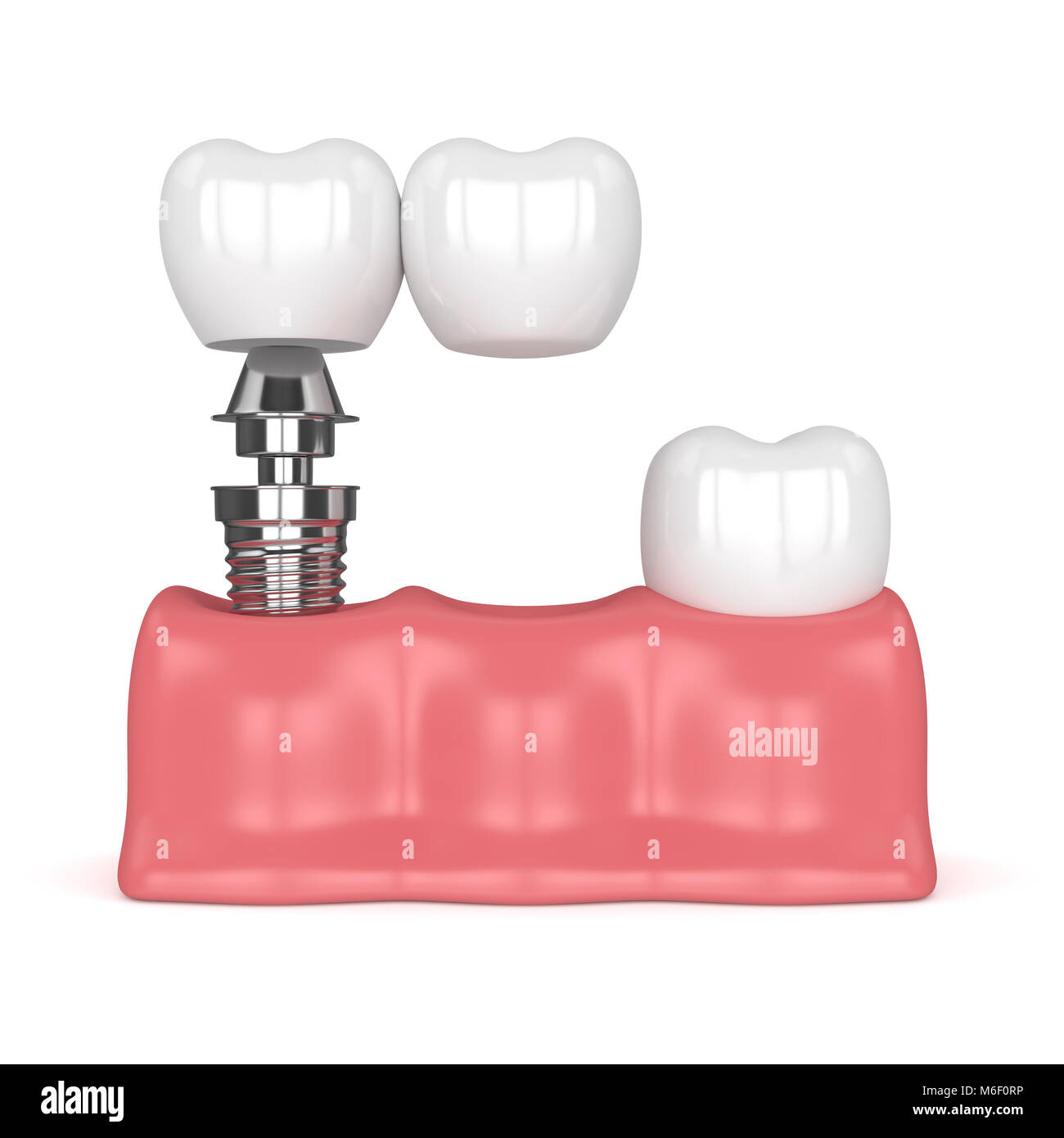 3d render of implant with dental cantilever bridge and healthy tooth in gums isolated over white