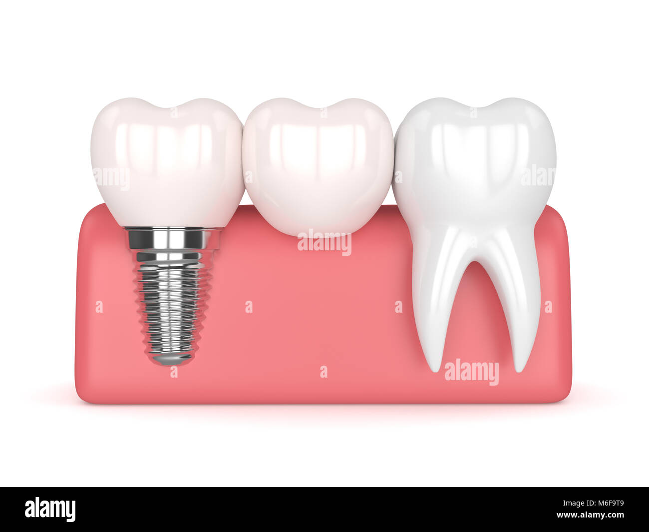 3d render of implant with dental cantilever bridge and healthy tooth in