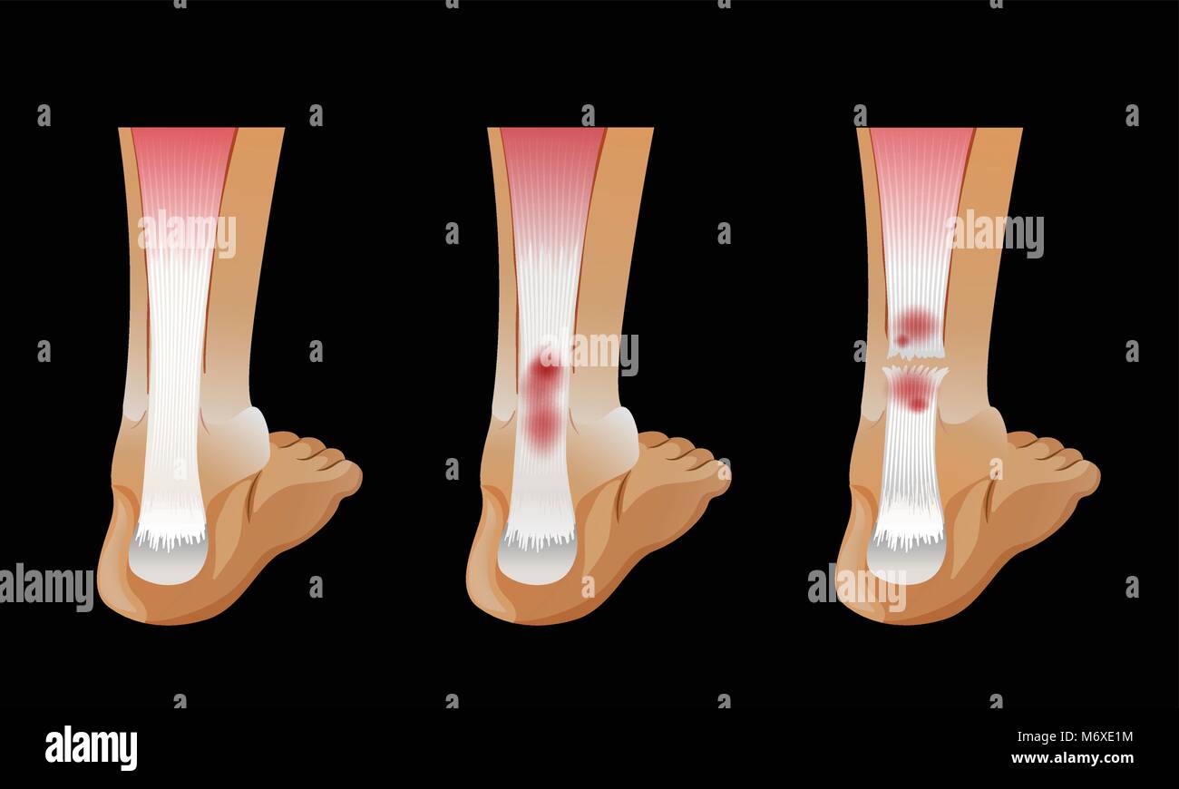Diagram showing broken bone in human foot illustration Stock Vector