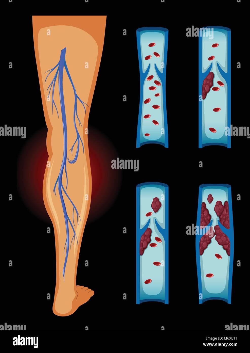 Blood clot in human leg illustration Stock Vector