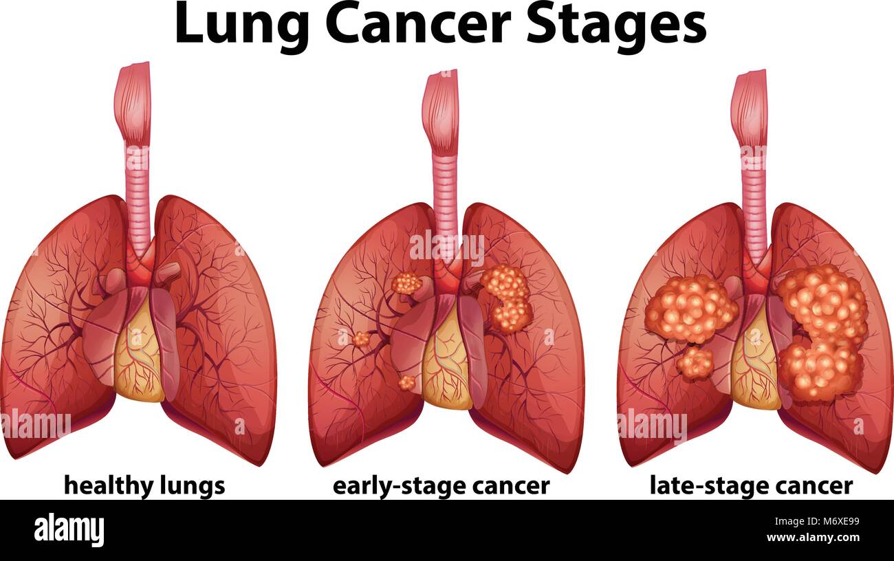 Diagram showing lung cancer stages illustration Stock Vector