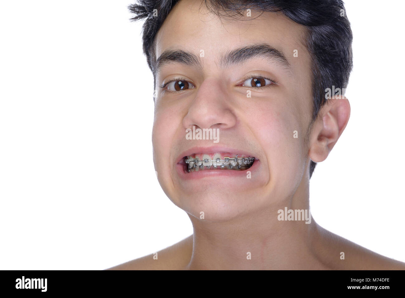 Boy braces hi-res stock photography and images - Alamy