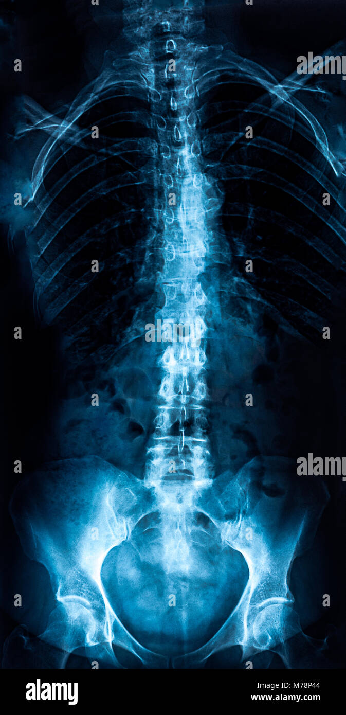Woman trunk x-ray, lumbosacral spine examination Stock Photo