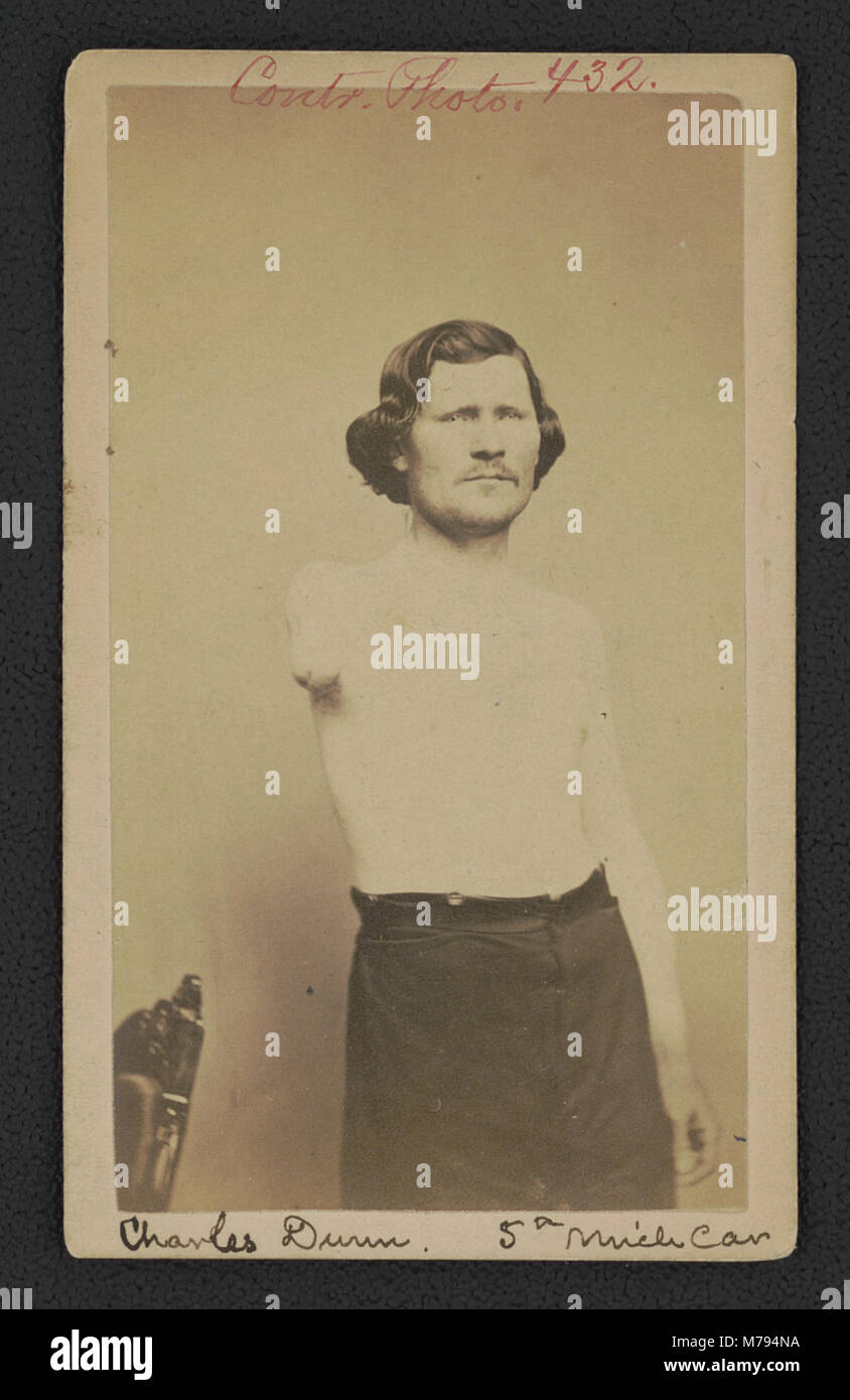 A poignant image of Private Charles Dunn from the 5th Michigan Cavalry Regiment, showing his arm amputation, a reminder of the sacrifices made during the Civil War. Stock Photo