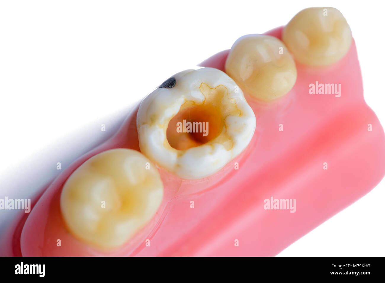 molar teeth