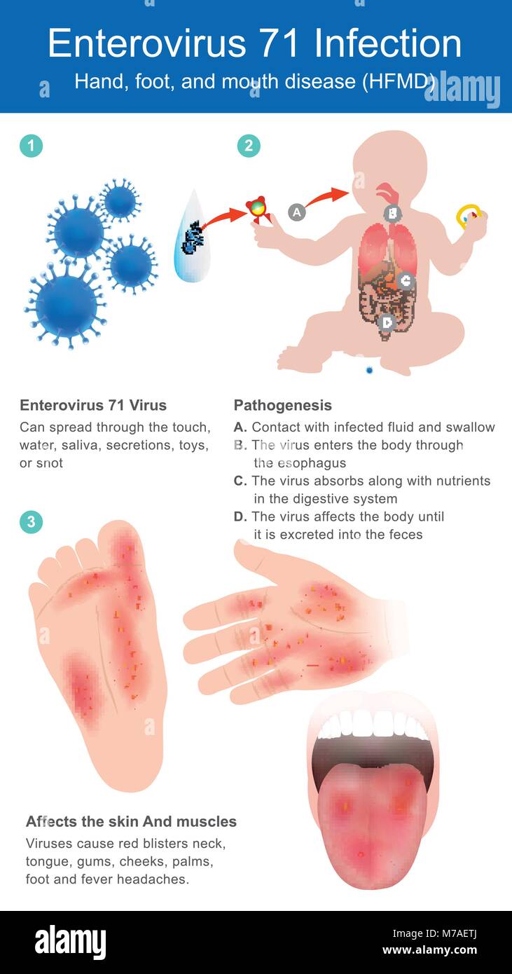 Virus can spread through the touch water, saliva, secretion, toys, or snot. Viruses cause red blisters neck, tongue, gums, cheeks, palms, foot, and fe Stock Vector