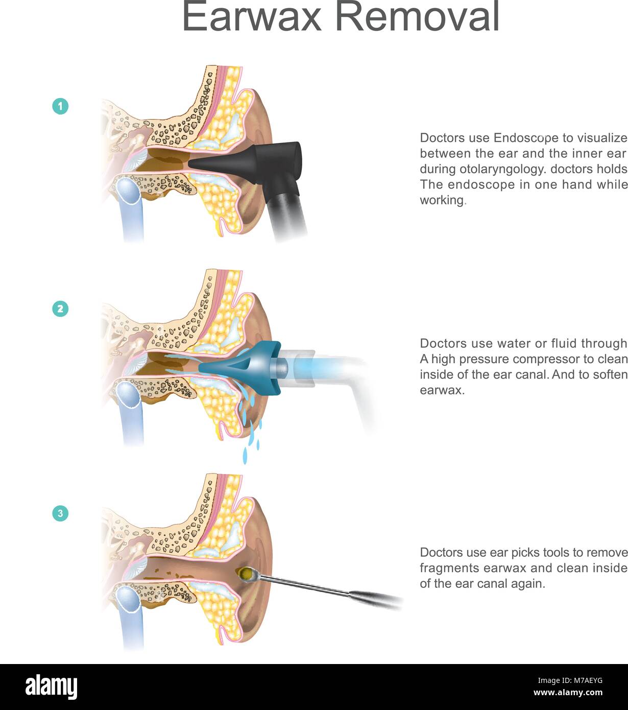 Doctors use water or fluid through a high pressure compressor to clean inside of the ear canal. And to soften earwax. Illustration. Stock Vector