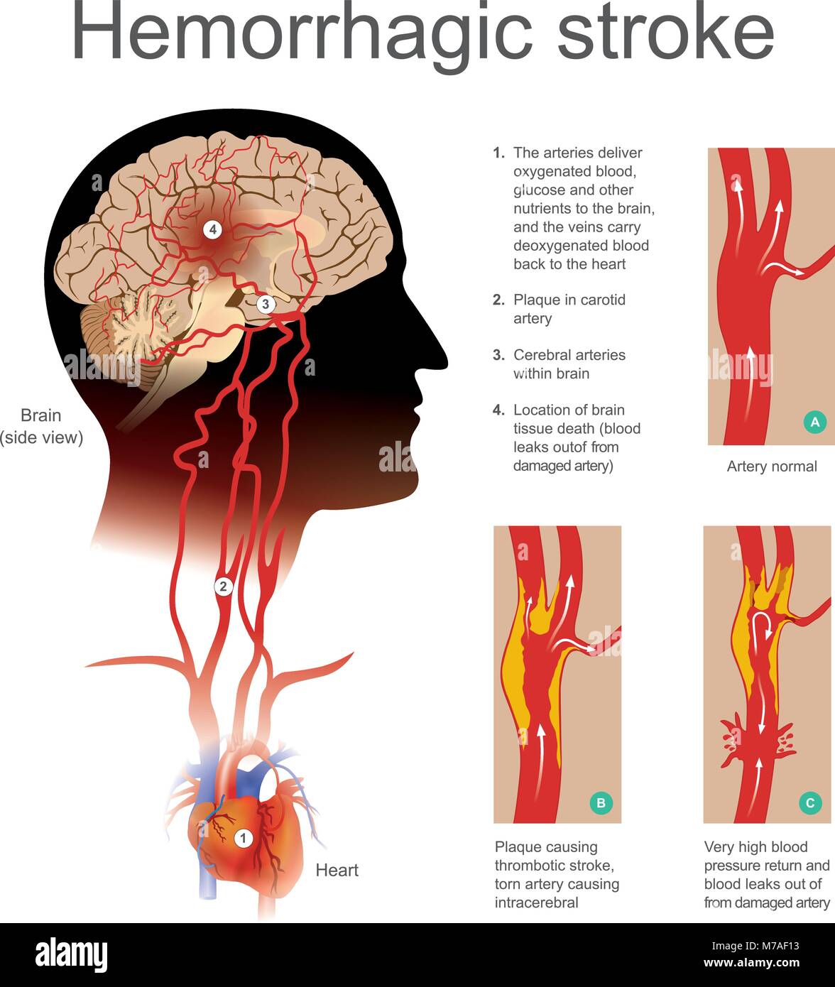 Plaque causing thrombotic stroke torn artery causing intracerebral. Very high blood return and blood leaks out of from damaged artery. Illustration hu Stock Vector