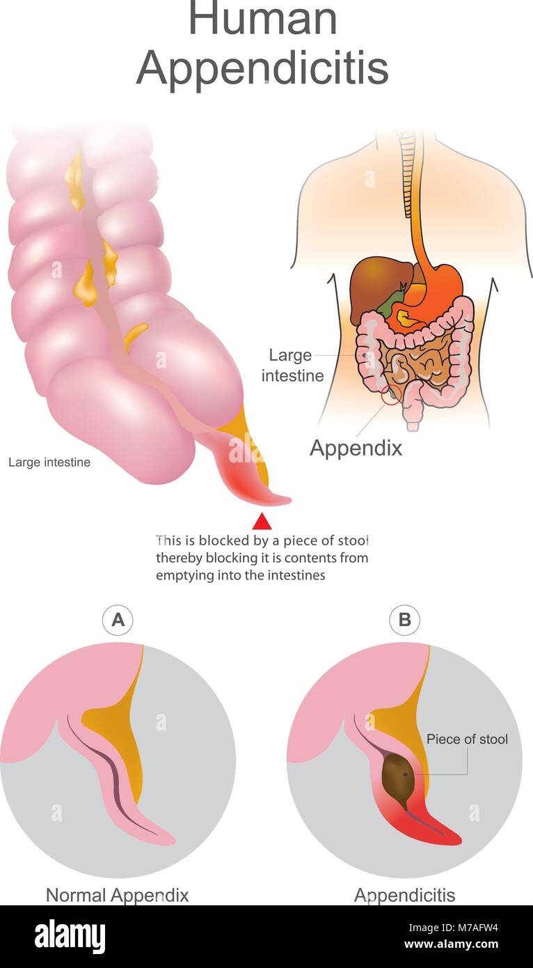 Human Appendicitis. A blocked by a piece of stool thereby blocking it is contents from emptying into intestines. Large Intestine system. Illustration  Stock Vector