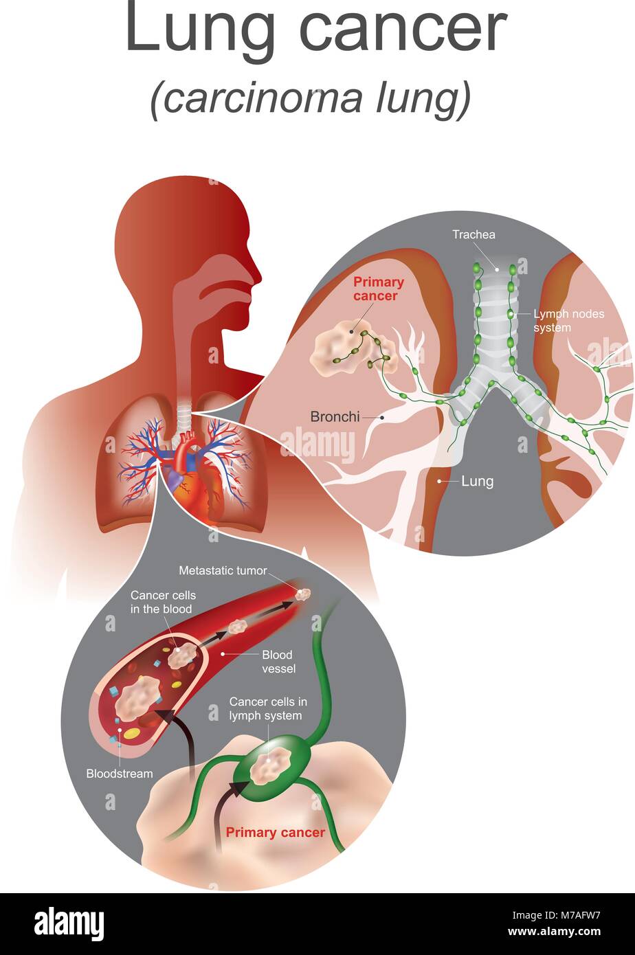 The Lung cancer is a malignant lung tumor characterized by uncontrolled cell growth in tissues of the lung. Lung system, Respiratory system. Illustrat Stock Vector