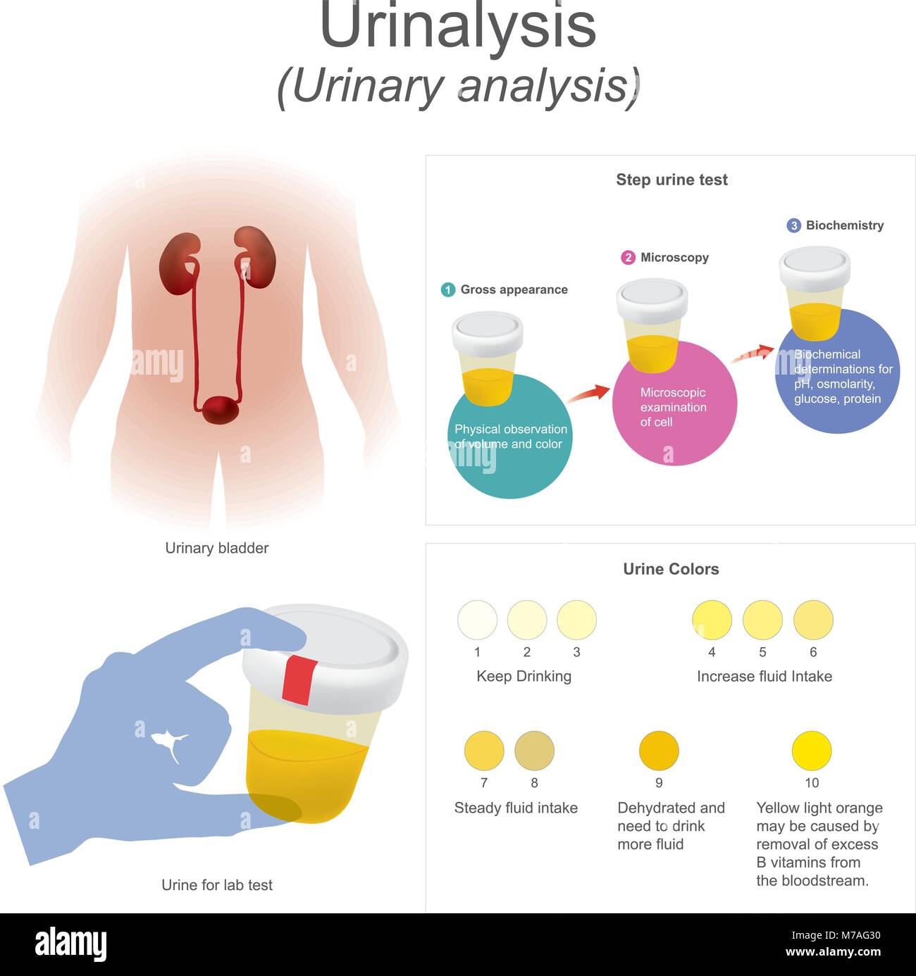 Urinalysis (urinary analysis) The lab test dips the strip into urine