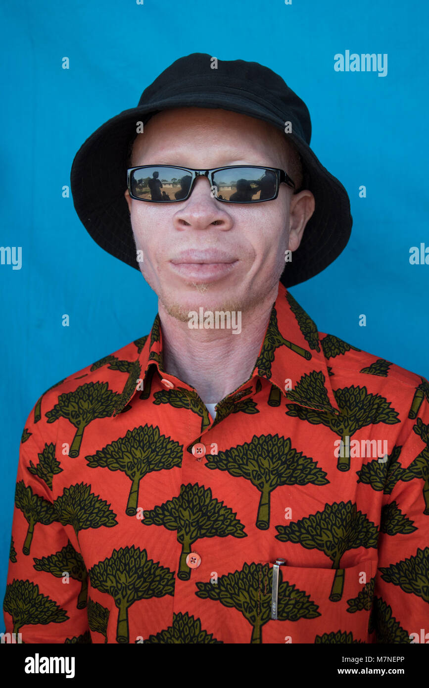 Tanzanian Man with Albinism Stock Photo