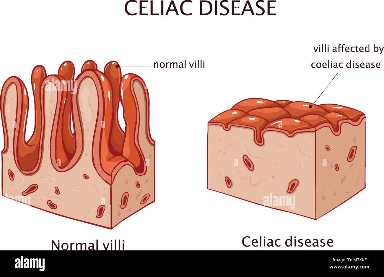 Coeliac disease or celiac disease. small bowel showing coeliac disease manifested by blunting of villi. Stock Vector