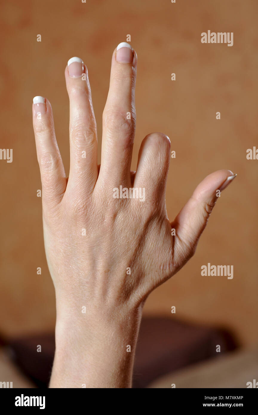 Amputation of the index finger of the left hand of a woman. Stock Photo