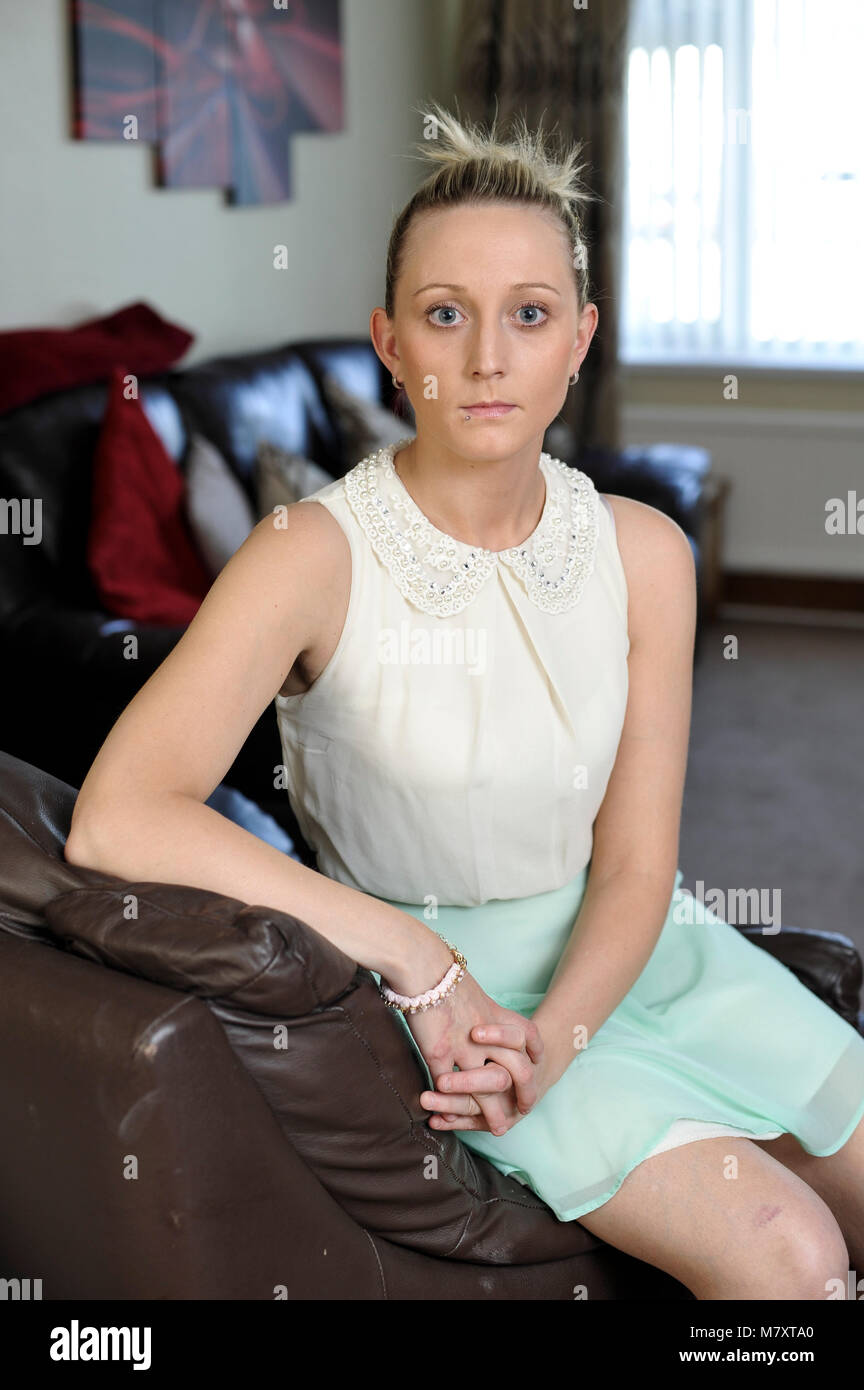 Jemma Jones was diagnosed with cancer of the oesophagus. She is one of the youngest person in the UK to be diagnosed with this type of cancer. Stock Photo