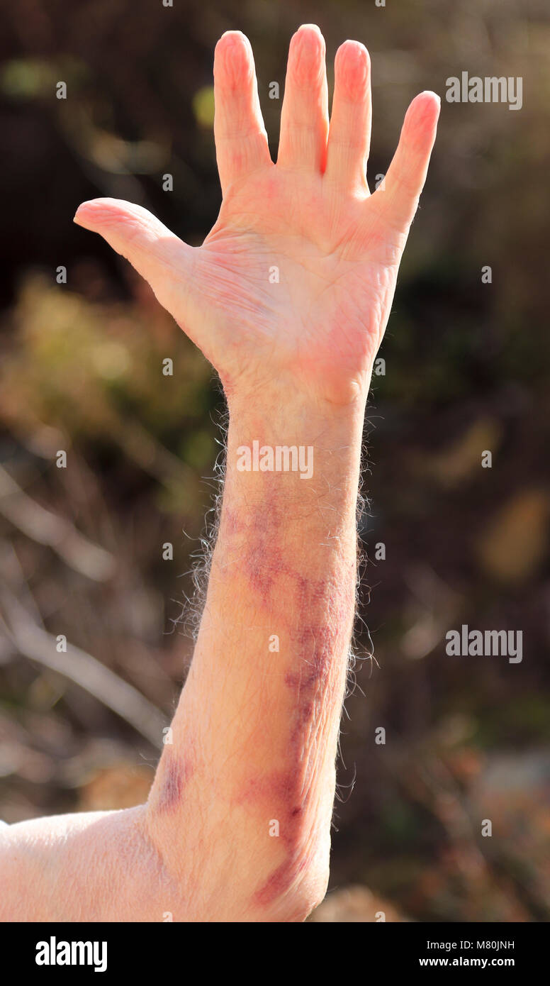 Bruising (hematoma) caused by internal bleeding as a result of a blood test having been performed. Stock Photo