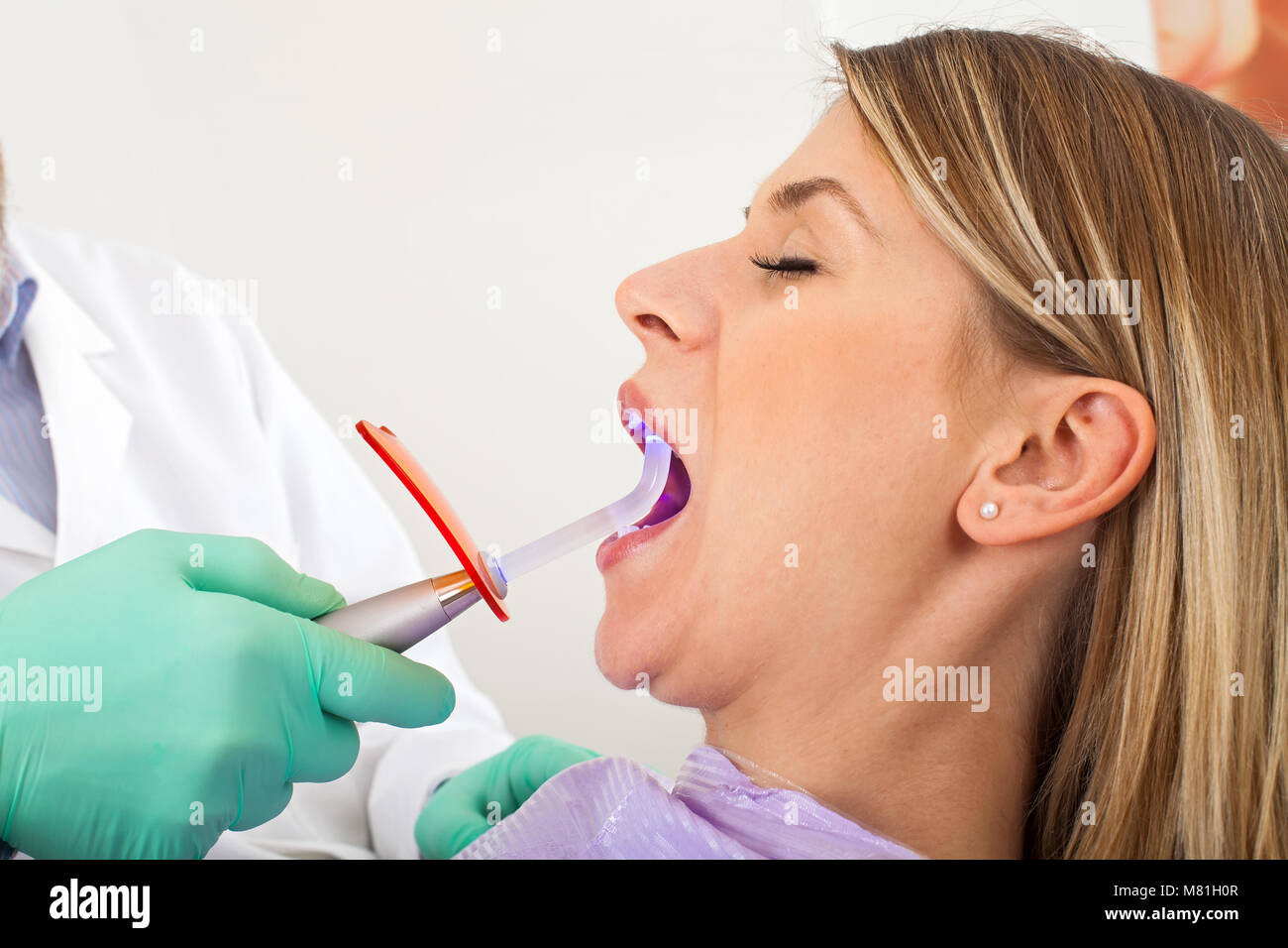 Close up picture of dental polymerization with uv lamp on young female patient Stock Photo Alamy