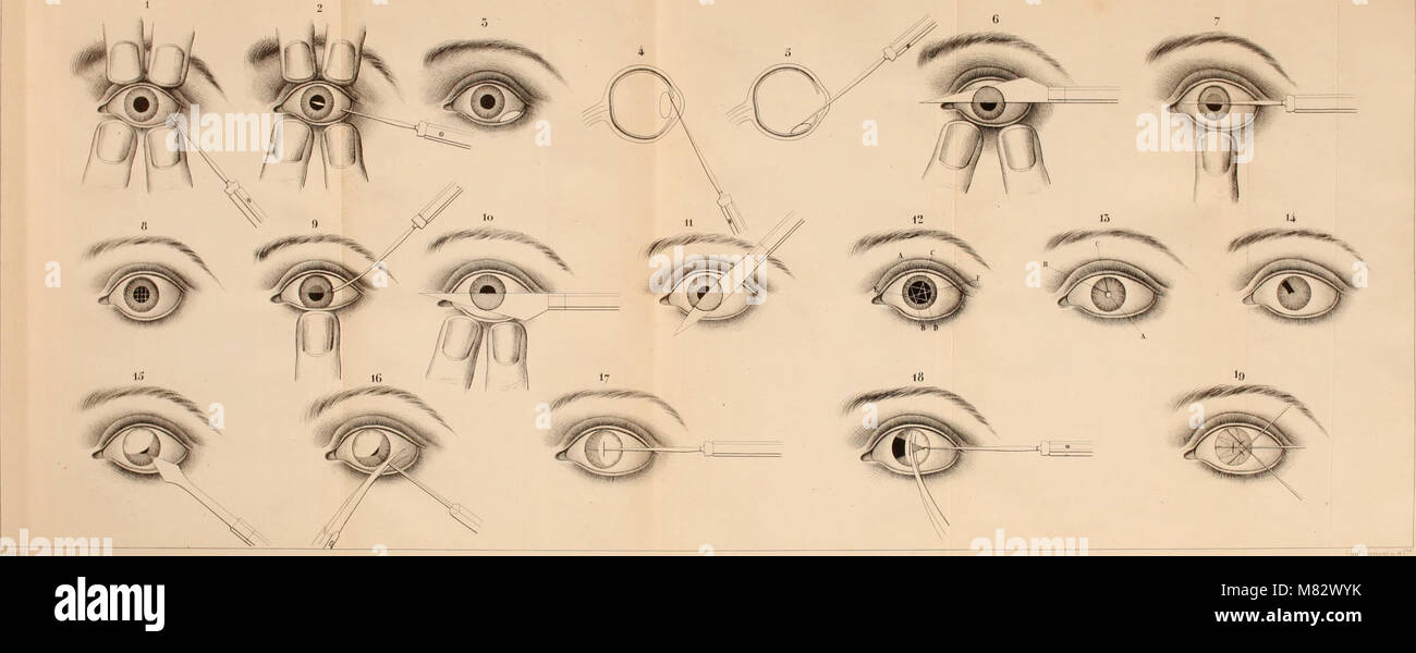 Chirurgie oculaire; ou, Traité des opérations chirurgicales qui se pratiquent sur l'oeil et ses annexes ouvrage contenant la pratique opératoire de F. Jaeger et de A. Rosas (1844) (14594958439) Stock Photo