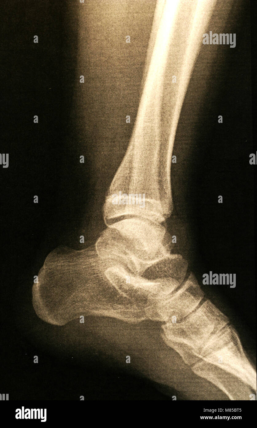 A X-ray of a foot Stock Photo