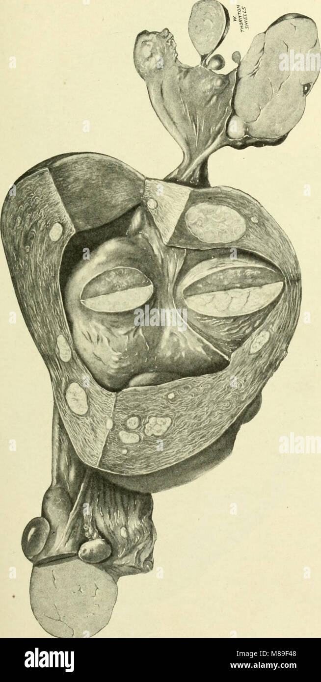 Fibroids and allied tumours (myoma and adenomyoma) - their pathology, clinical features and surgical treatment (1918) (14594067197) Stock Photo