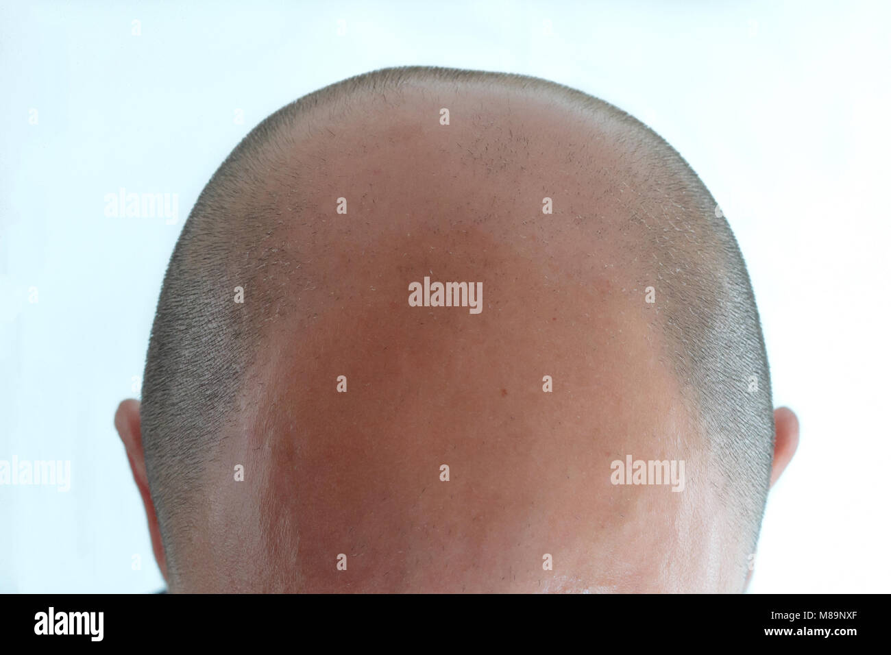 View of bald man's head with hair loss Stock Photo