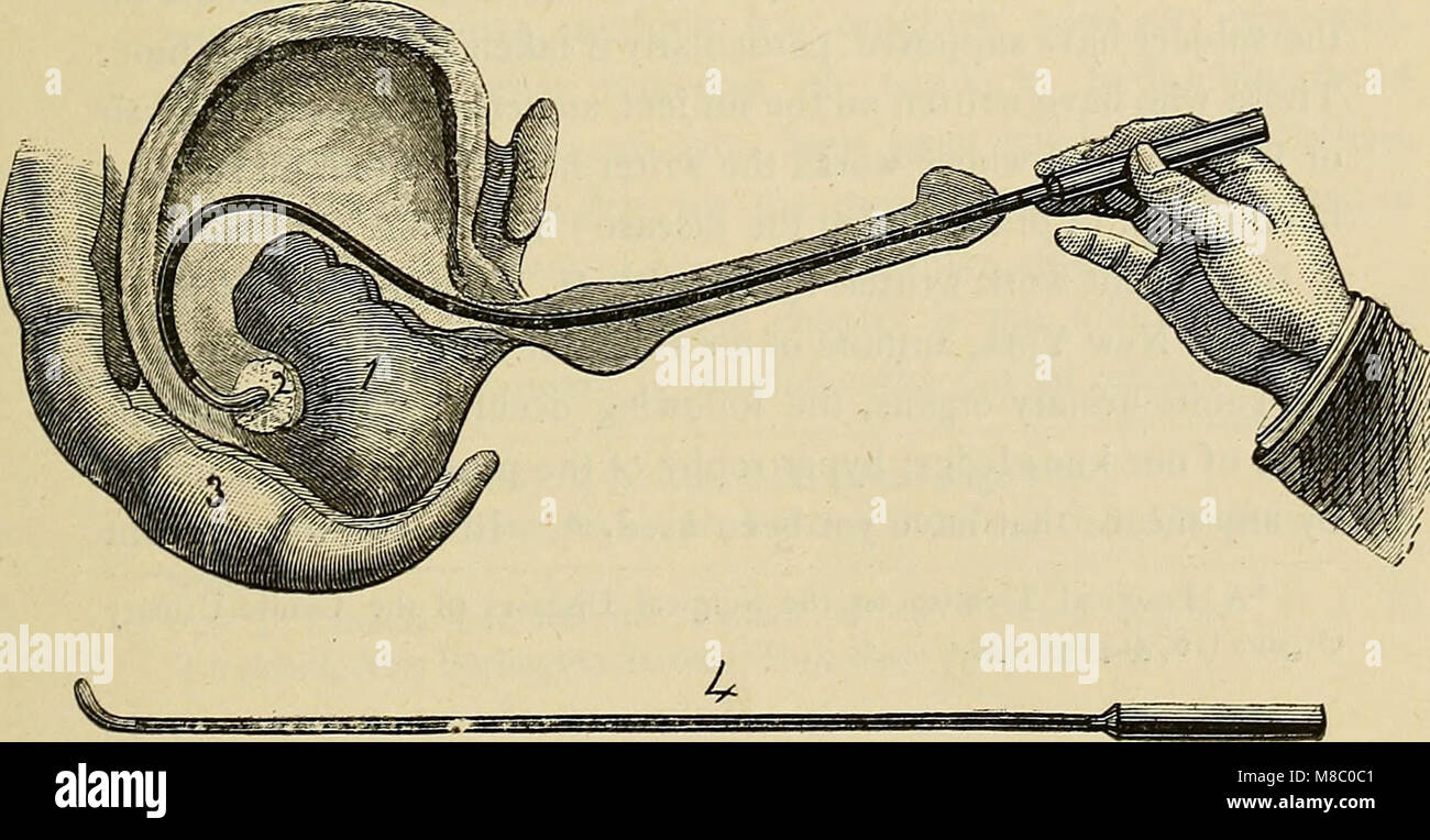 Diseases of the bladder and prostate, and obscure affections of the urinary organs, with diagrams illustrating the author's treatment of stone, without cutting, and numerous successfully treated cases (14787273873) Stock Photo