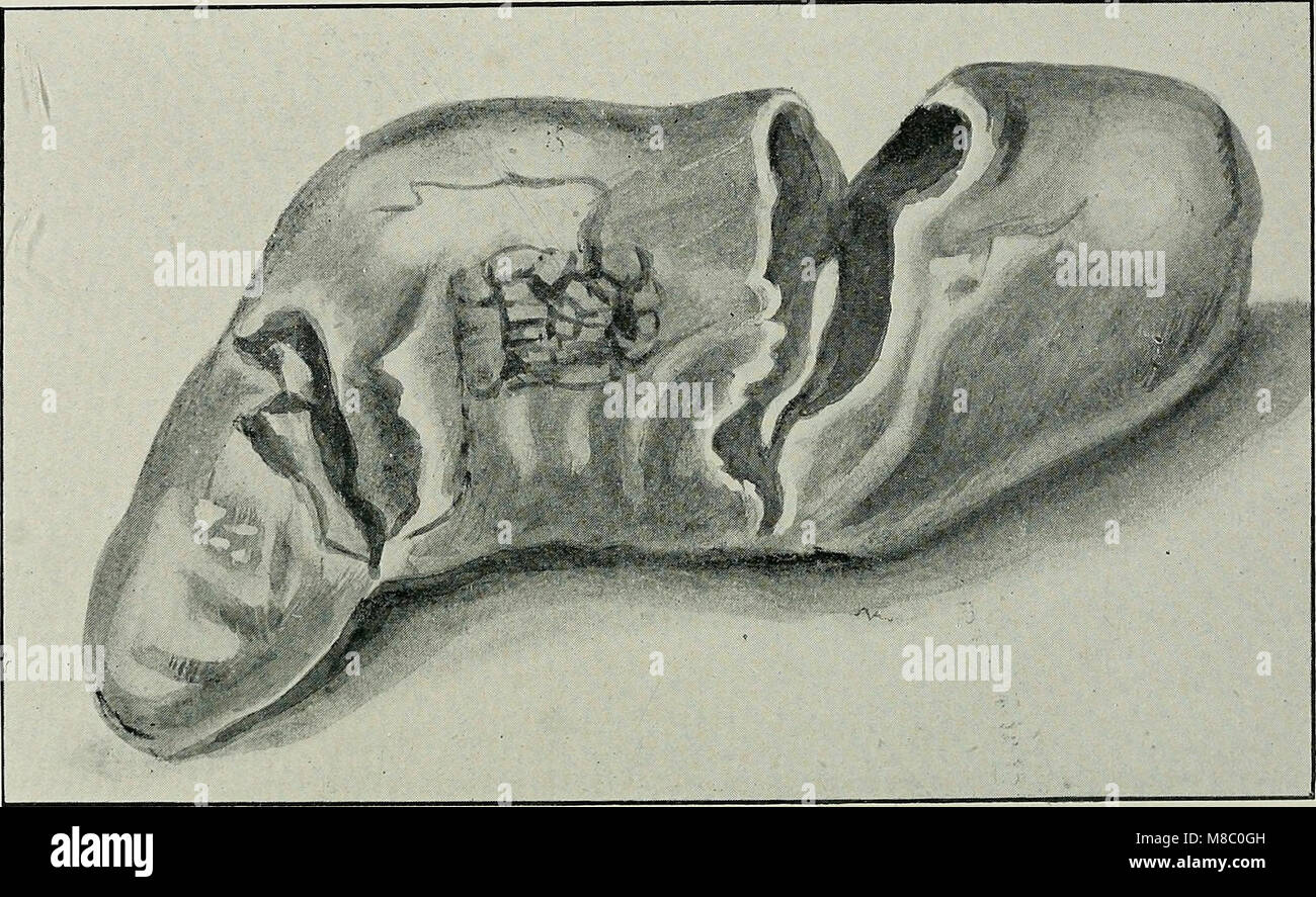 Diseases of the gall-bladder and bile-ducts, including gall-stones (1900) (14755018991) Stock Photo