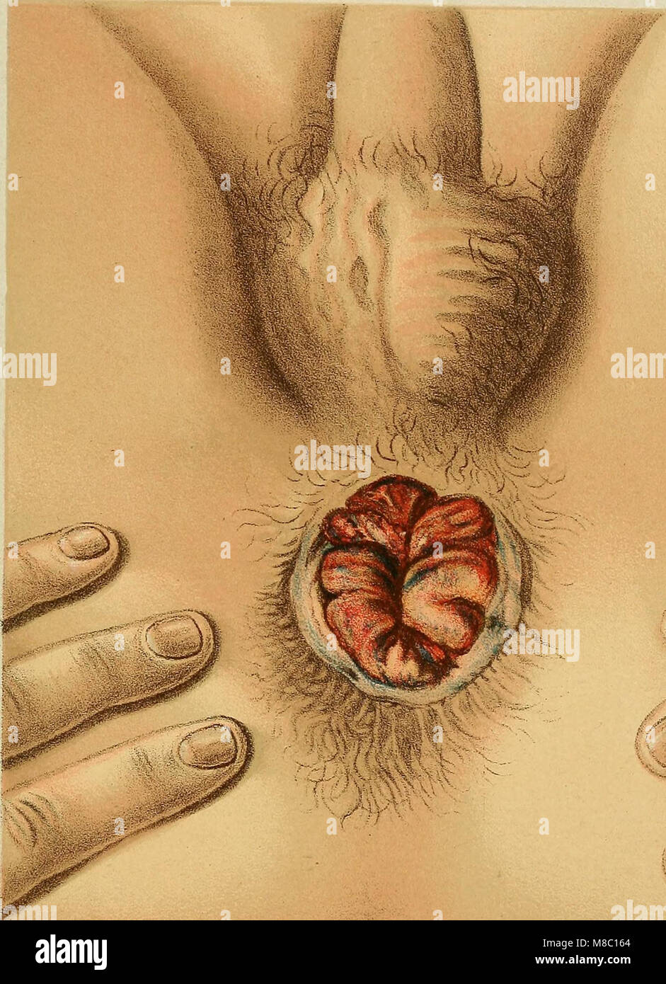 diseases of the anus Diseases of the anus
