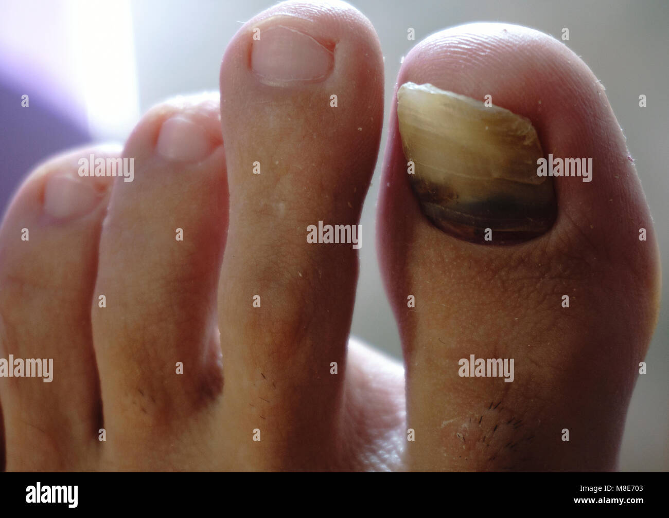 Toe Nail Fungus Stock Photos & Toe Nail Fungus Stock Images Alamy