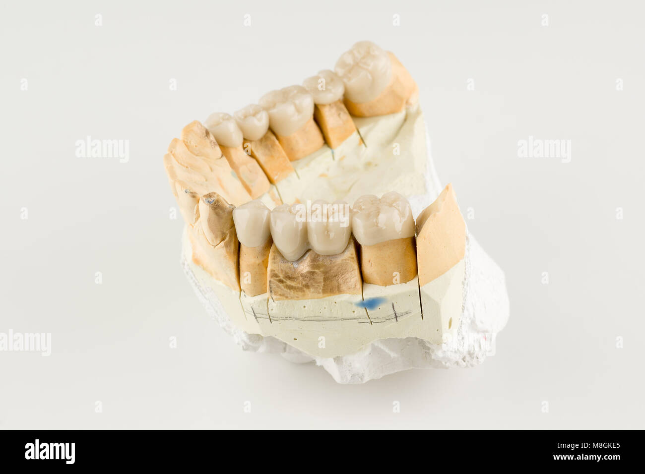 artificial dental structures made of ceramics for restoration of