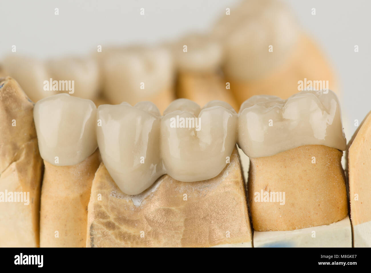 artificial dental structures made of ceramics for restoration of