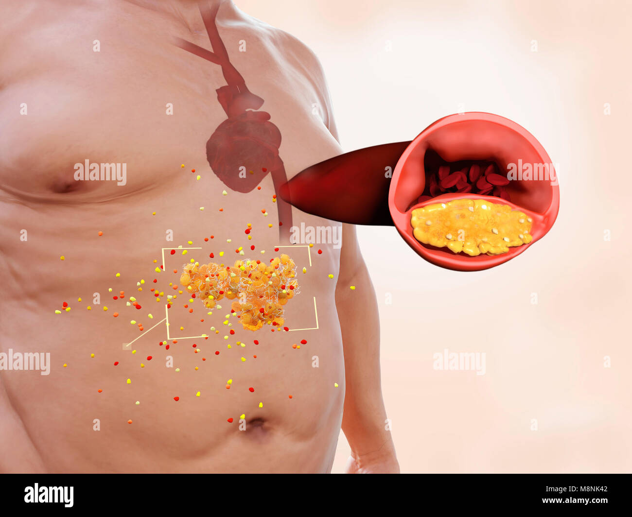 Visceral fat and heart disease, illustration. Visceral fat is highly