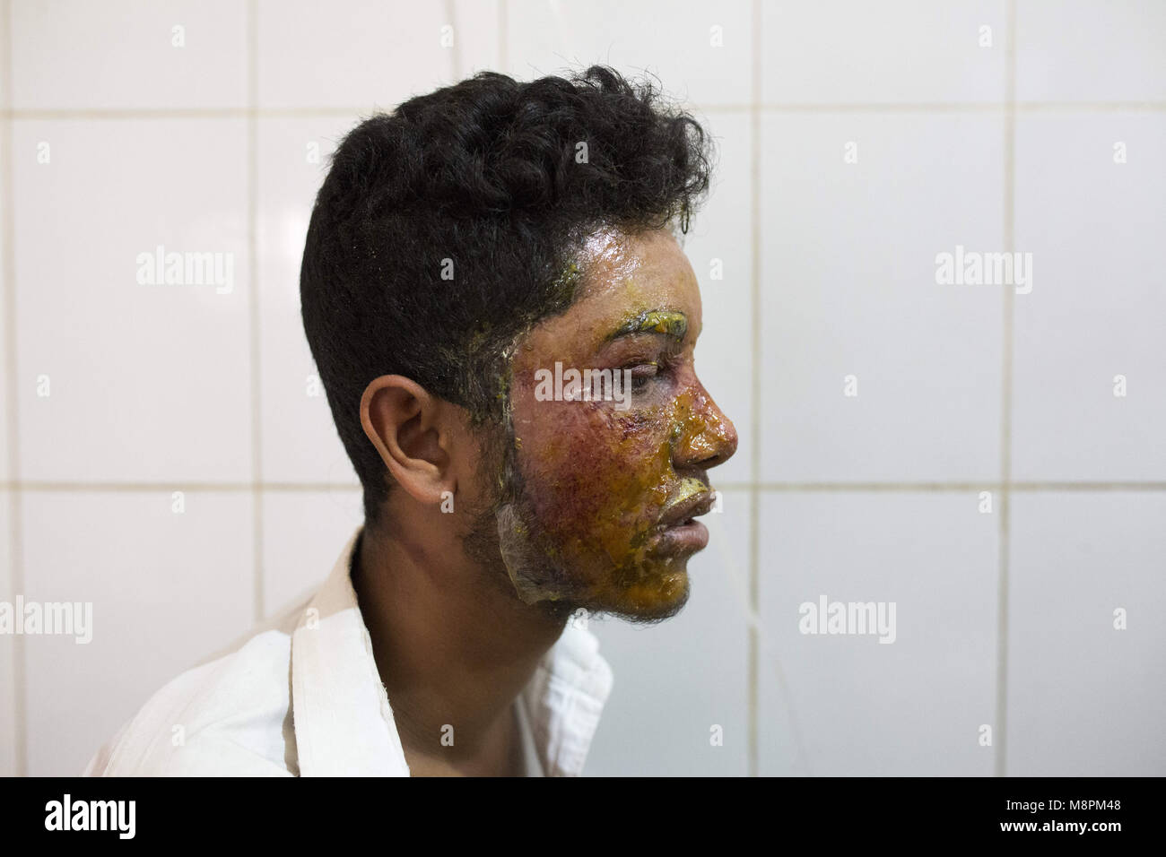 Dhaka, Bangladesh. 19th Mar, 2018. Mahmudul Hasan Maruf, suffers from acid  attack thrown by a girl cause of refusal of love has admitted in Dhaka,  Bangladesh Medical for treatment in Dhaka, Bangladesh,